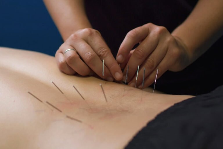 Unveiling the Side Effects of Dry Needling