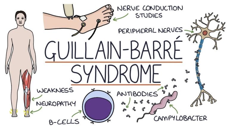 Navigating the Challenges of Guillain-Barré Syndrome with Compassionate Care