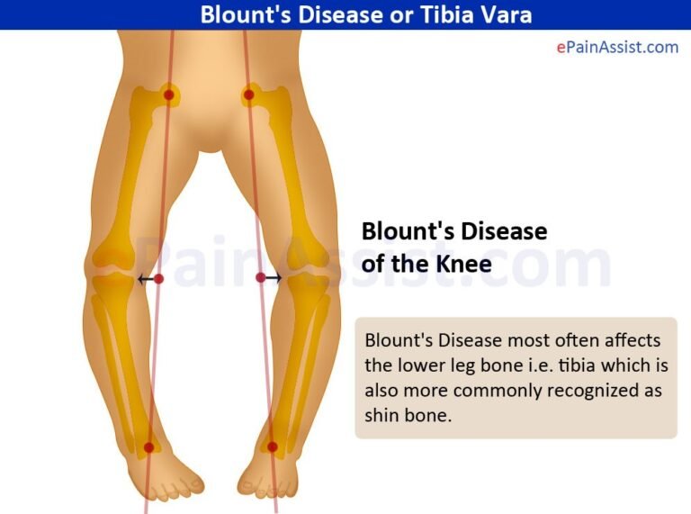 Compassionate Approach to Blount’s Disease Treatment at Physio Needs Academy