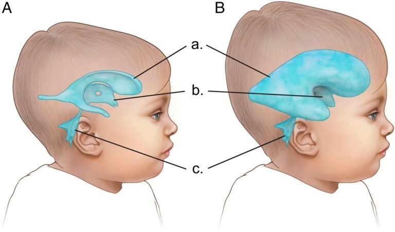 Compassionate Care and Physiotherapy for Hydrocephalus