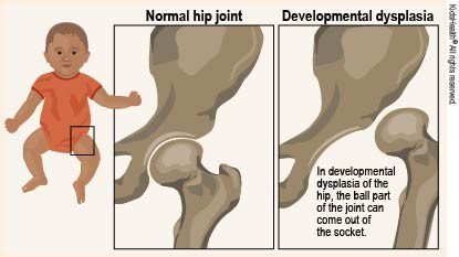 Nurturing Hope: Understanding and Managing Developmental Dysplasia of the Hip